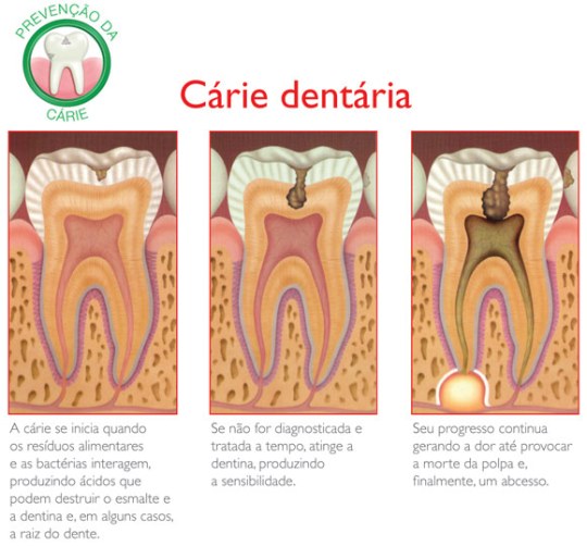 http://www.colgateprofissional.com.br/pacientes/Carie-dentaria/imagem
